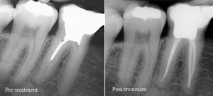 Understanding Root Canal Treatment